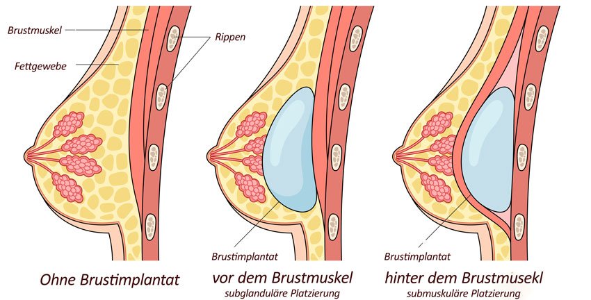 implantatlagen